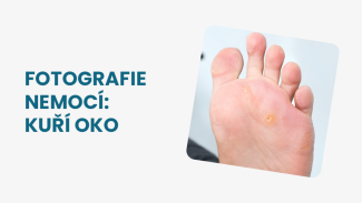 Náhledový obrázek - Kuří oko foto: Jak vypadá a v čem se liší od bradavice či puchýře?