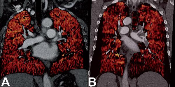 Obr. 21 – CT angiografie plicních tepen duální energií. Z vyšetření lze hodnotit nejen lumen samotných cév, zobrazení duální energií umožňuje zobrazit koncentraci jodové kontrastní látky v parenchymu a tak aproximovat perfúzi. A) Pacient bez detekovatelných embolů v tepnách. Zobrazení „perfúze“ je homogenní. B) Pacient s masivní embolizací. Barevné zobrazení ukazuje nehomogenní rozložení kontrastní látky a tmavší oblasti odpovídají hypoperfundovaným částem plicního parenchymu.