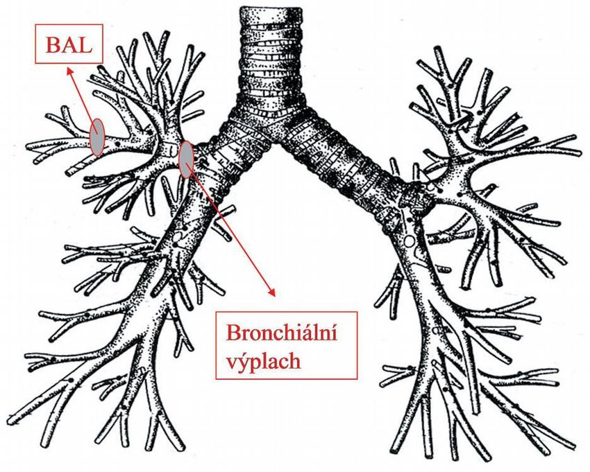 Obr. – Lokalizace provedení bronchoalveolární laváže a bronchiálního výplachu