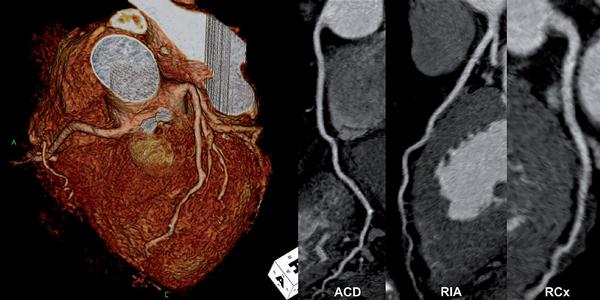 Obr. 4 – CT koronarografie s minimálními aterosklerotickými změnami, bez významné stenózy. Vlevo je 3D VRT obraz, vpravo jednotlivé hlavní tepny v zakřivených planárních rekonstrukcích. ACD – arteria coronaria dextra, RIA – ramus interventricularis anterior, RCx – ramus circumflexus