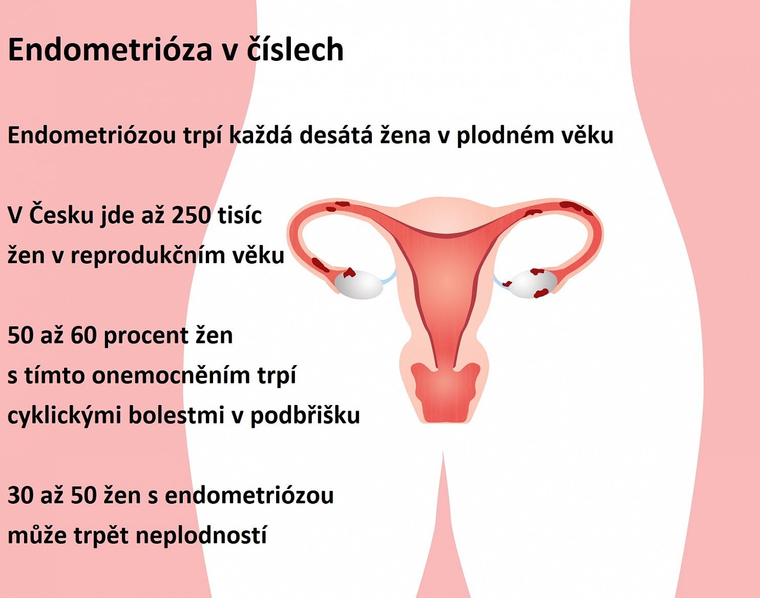 Endometrióza v číslech