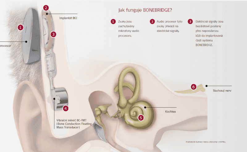 První operace ušního implantátu BONEBRIDGE