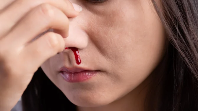 Jak Zastavit Krvácení Z Nosu Tipy A Triky Zdravíeurocz 0994