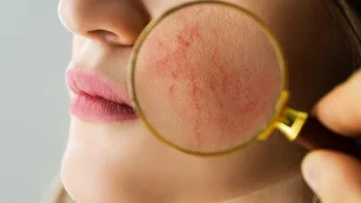 Náhledový obrázek - Rosacea se vyskytuje obvykle u lidí se světlou pletí. Nejčastěji postihuje tváře a nos