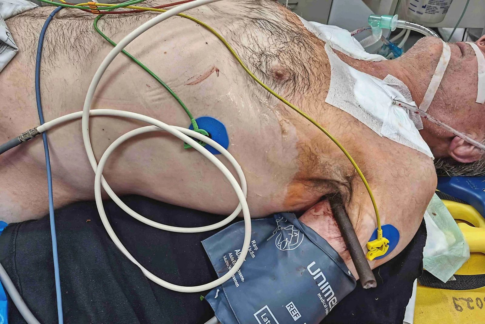 Tyč propíchla hrudník skrz naskrz a projela oběma plicními laloky.