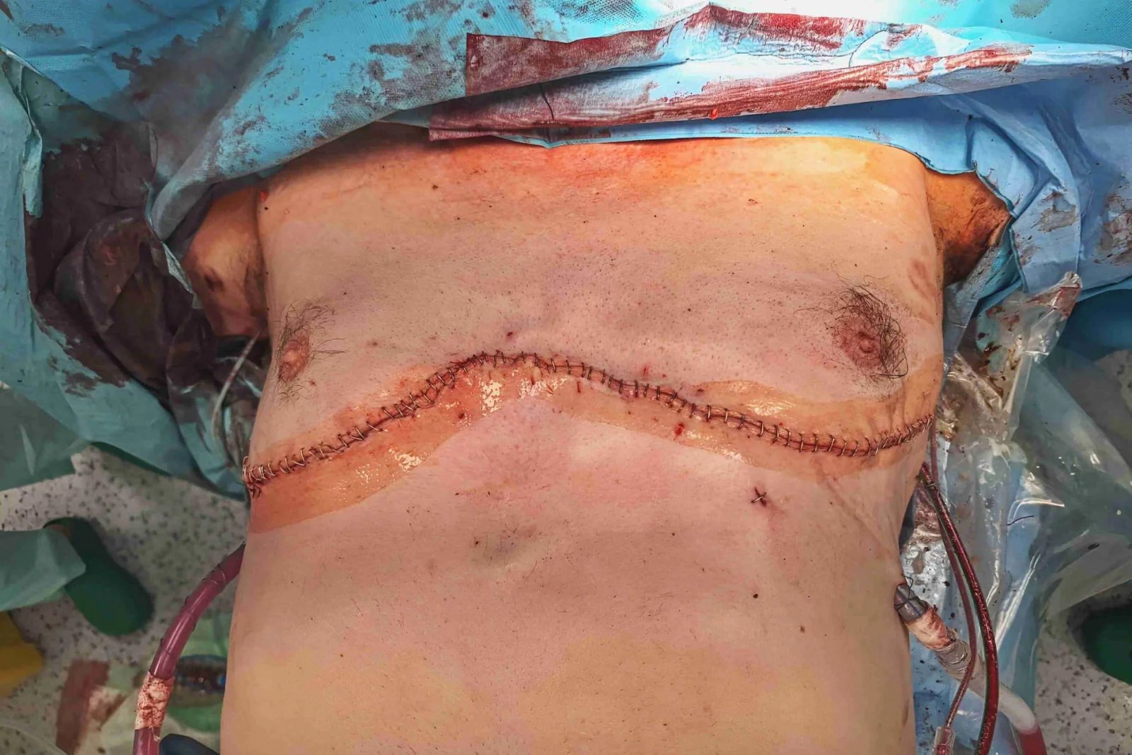 Takto široký řez nebývá zvykem. Chirurgové jej používají třeba při transplantacích nebo mnohačetných poraněních hrudníku.
