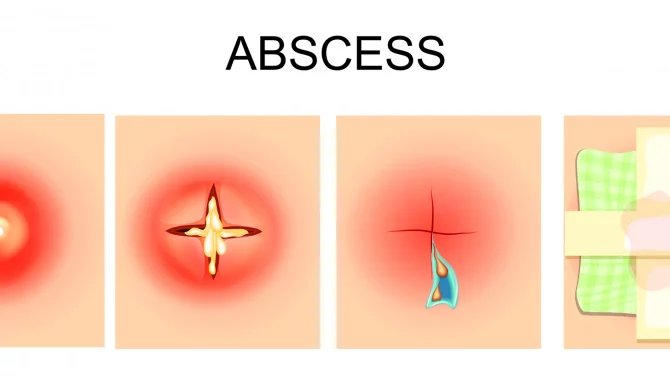 S abscesem se lze setkat kdekoliv na kůži i uvnitř těla. Mnohdy se jedná o velice bolestivé onemocnění, které si žádá včasnou léčbu. Původcem zánětu jsou ve většině případů bakterie, konkrétně stafylokoky a streptokoky.