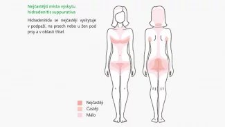 S hidradenitidou se v Česku potýká odhadem na sto tisíc lidí. Protože ale povědomí o nemoci není příliš silné a její příznaky jsou zaměnitelné s jinými kožními nemocemi, na diagnózu pacienti čekají léta.
