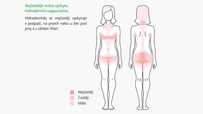 S hidradenitidou se v Česku potýká odhadem na sto tisíc lidí. Protože ale povědomí o nemoci není příliš silné a její příznaky jsou zaměnitelné s jinými kožními nemocemi, na diagnózu pacienti čekají léta.