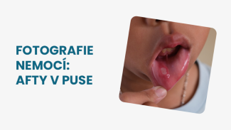 Náhledový obrázek - Afty v puse foto: Jak je poznat a podle čeho je odlišit od jiných útvarů vyskytujících se v ústech?