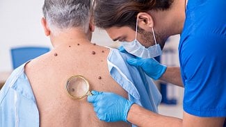 Náhledový obrázek - Stařecké bradavice nejsou zdraví nebezpečné. Pozor však na záměnu s melanomem