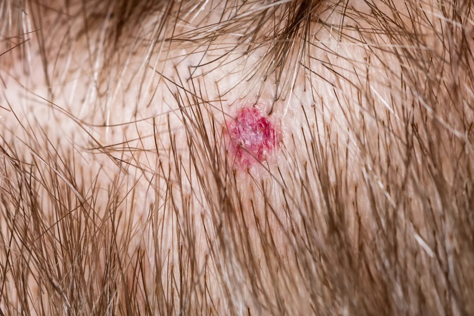 Strupy na hlavě občas bývají doprovodným symptomem některého ze zdravotních stavů, jenž vyžaduje terapii. Patří sem i kontaktní dermatitida nebo dobře známá lupénka ve vlasech.