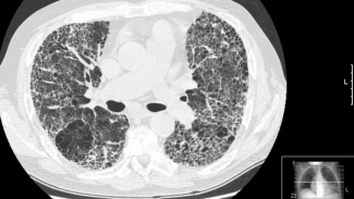 Náhledový obrázek - Idiopatická plicní fibróza (IPF) představuje pro lidi vysokou zátěž