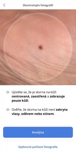 Znaménko pomocí aplikace jednoduše vyfotíte. Fotoaparát je potřeba držet 10-20 cm od kůže.