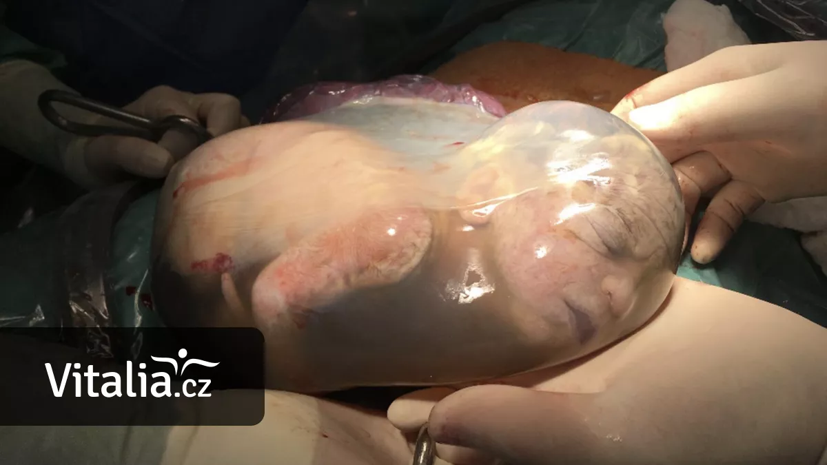 U předčasných porodů se snaží o to, aby se dítě narodilo ve vaku blan