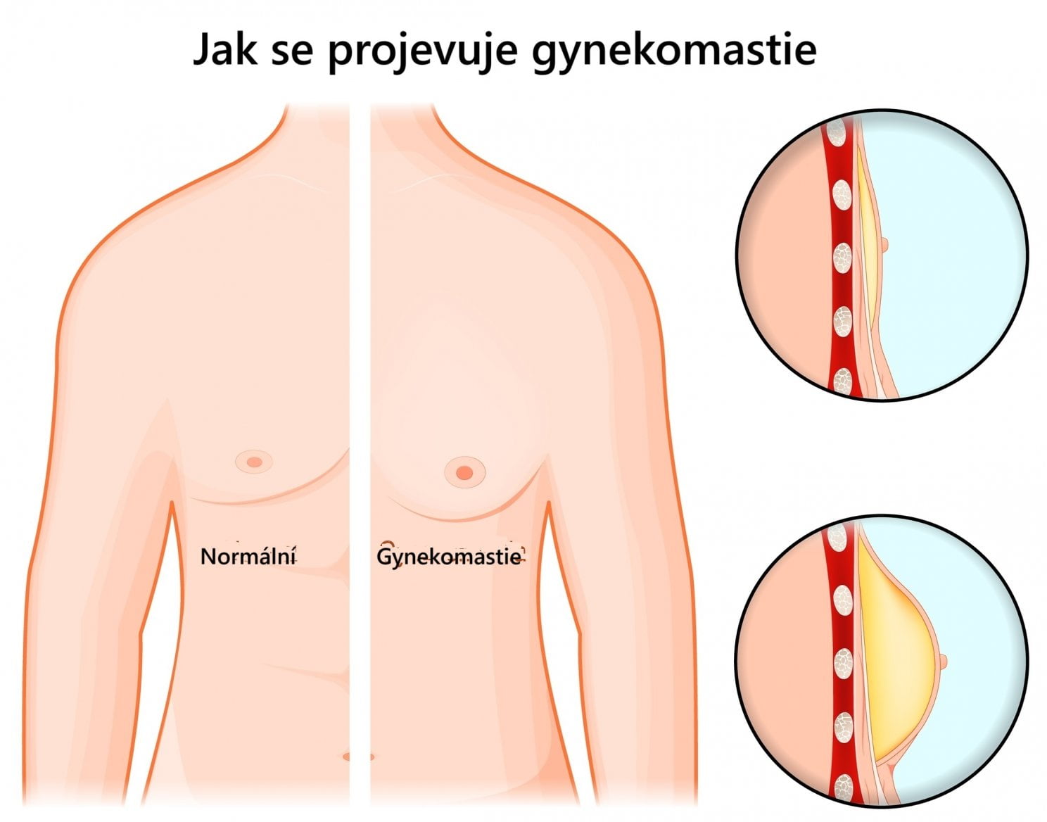 Jak vypadá gynekomastie
