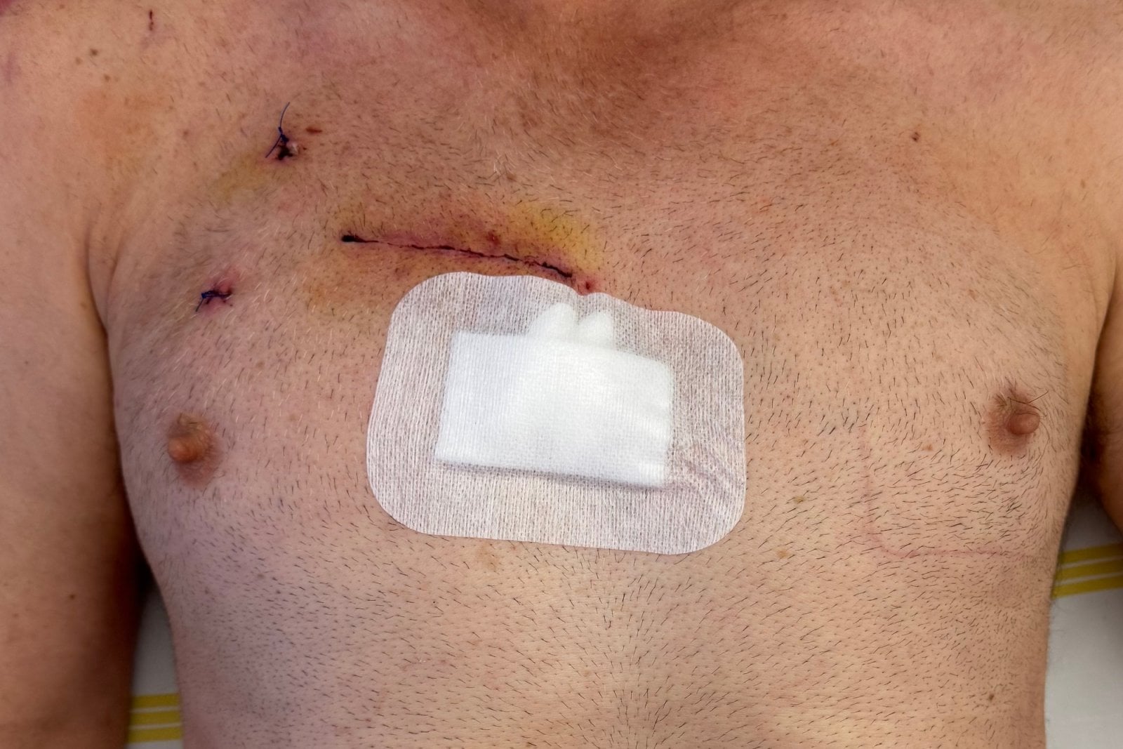 Lékaři z FN Olomouc začali operovat chlopeň miniinvazivně