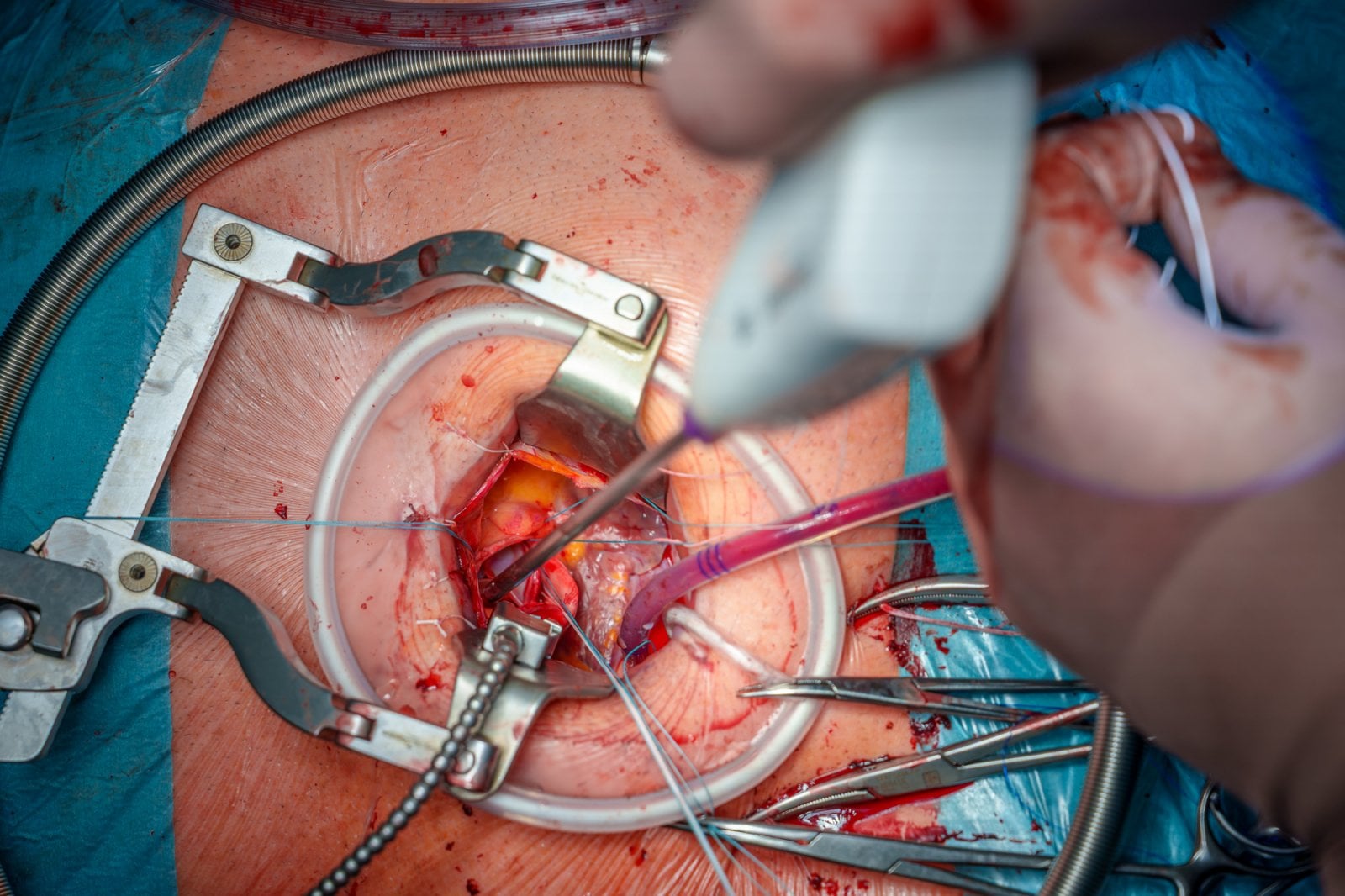 Lékaři z FN Olomouc operují chlopeň miniinvazivně