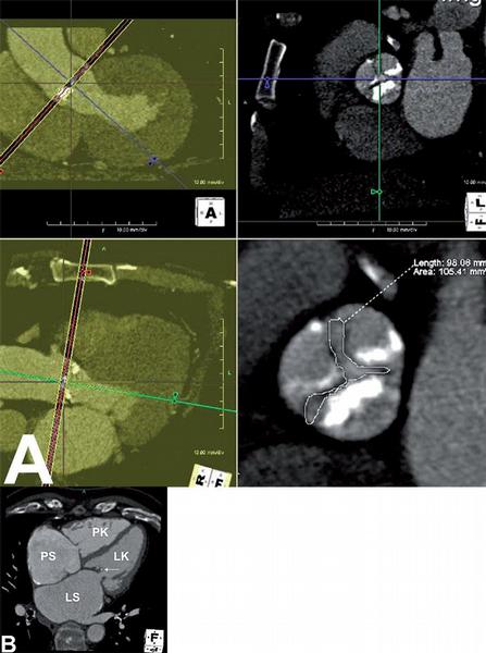 Obr. 14 – Zobrazení chlopní. A) Degenerativní výrazně kalcifikované postižení aortální chlopně. Planimetrické změření plochy aortální chlopně. B) Porevmatické stenózy mitrální i trikuspidální chlopně. Cípy jsou zesíleny, v předním cípu mitrální chlopně zachycena drobná kalcifikace (šipka). Levá komora (LK), levá síň (LS), pravá komora (PK), pravá síň (PS).