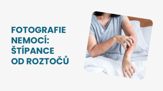 Náhledový obrázek - Štípance od roztočů foto: dostavuje se různá forma kožní dermatitidy. Zabírá proti nim pravidelná výměna prádla