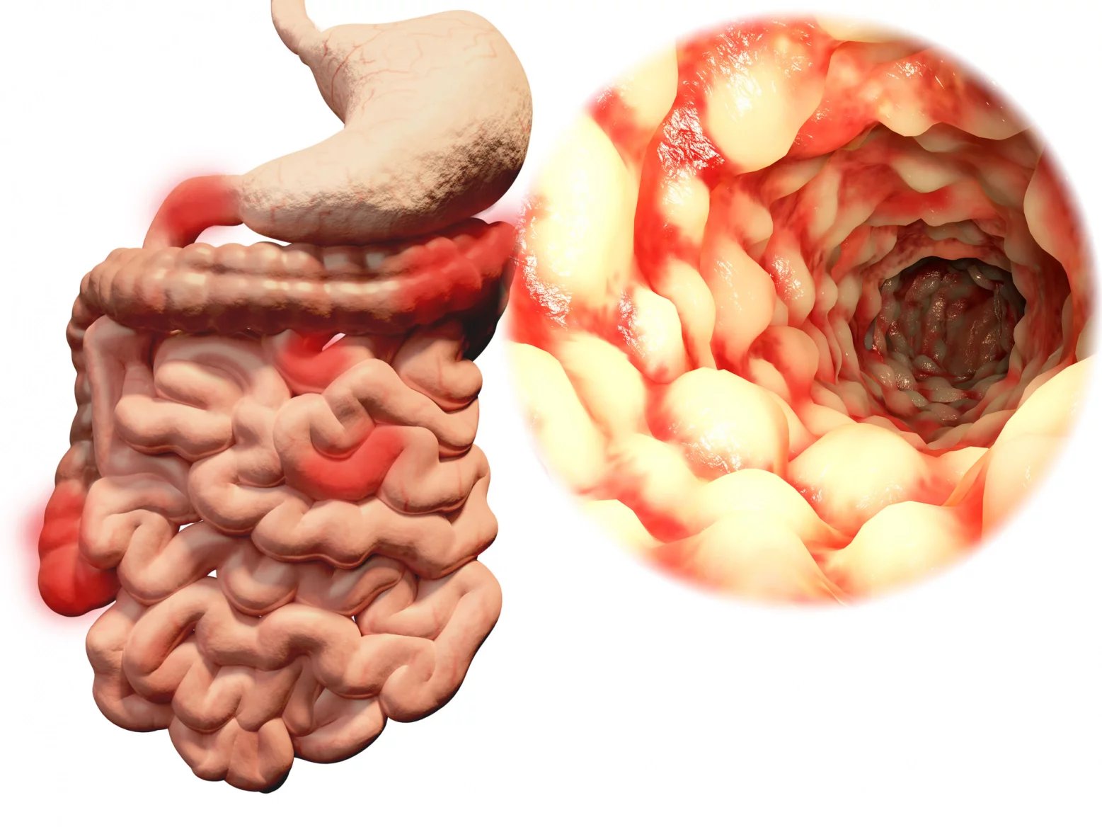 Řada pacientů s Crohnovou nemocí má její příznaky řadu let před stanovením diagnózy. Ve srovnání s ulcerózní kolitidou (colitis ulcerosa) jsou počáteční symptomy této nemoci méně zřetelné.