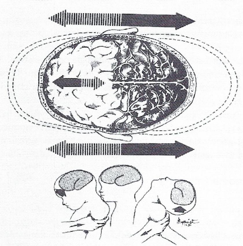 Obr. 1 – Mechanismus vzniku nitrolebního poranění při třesení hlavičkou dítěte (převzato z Tutsch-Bauer a kol., Rechtsmedizin 5, 2005)