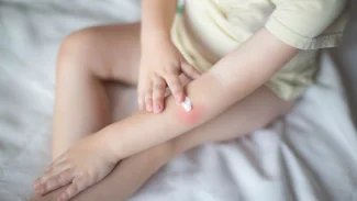 Náhledový obrázek - Vlk je běžné kožní onemocnění. Nejčastěji se objevuje v záhybech kůže