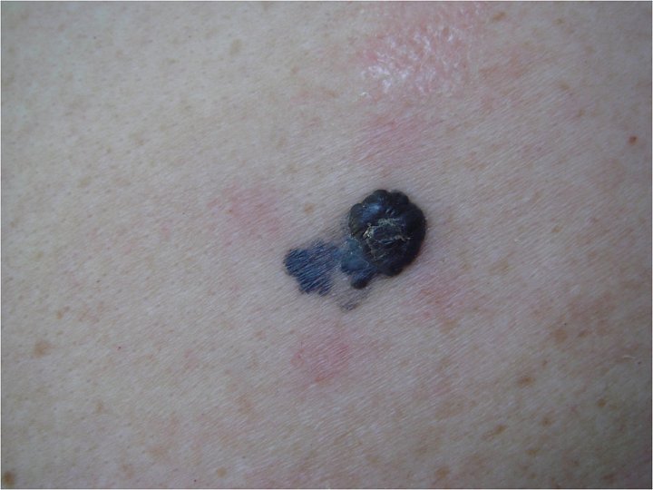 Incidence melanomu roste