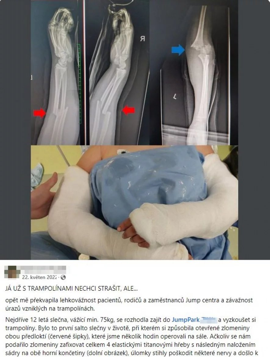 Tento příspěvek je od nemocničního ortopeda-traumatologa, který na Facebooku opakovaně upozorňuje na rizika trampolín. Mimo jiné tím, že popisuje úrazy, které sám jako lékař vidí. Ale také tak, že opakuje zásady bezpečnéhého chování na trampolínách.