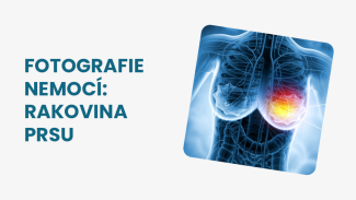 Náhledový obrázek - Rakovina prsu obrázky: pozná se podle bulky nebo změn na kůži
