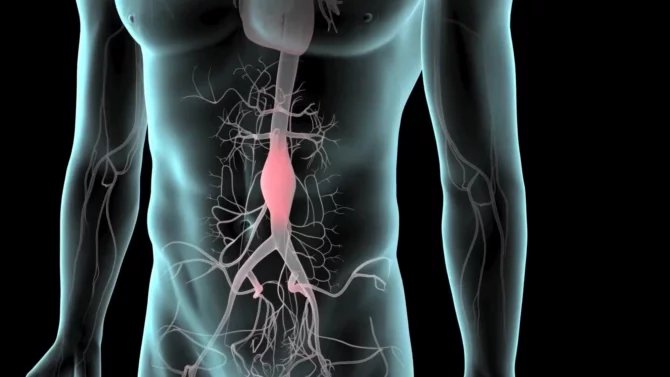 Zobrazení výdutě břišní aorty - aneurysma