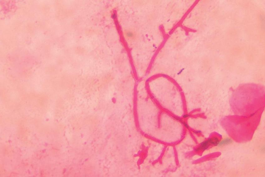 Obr. 2 – Aspergillus (septovaná mycelia, dichotomické větvení) v preparátu z BAT, barveno Gramem