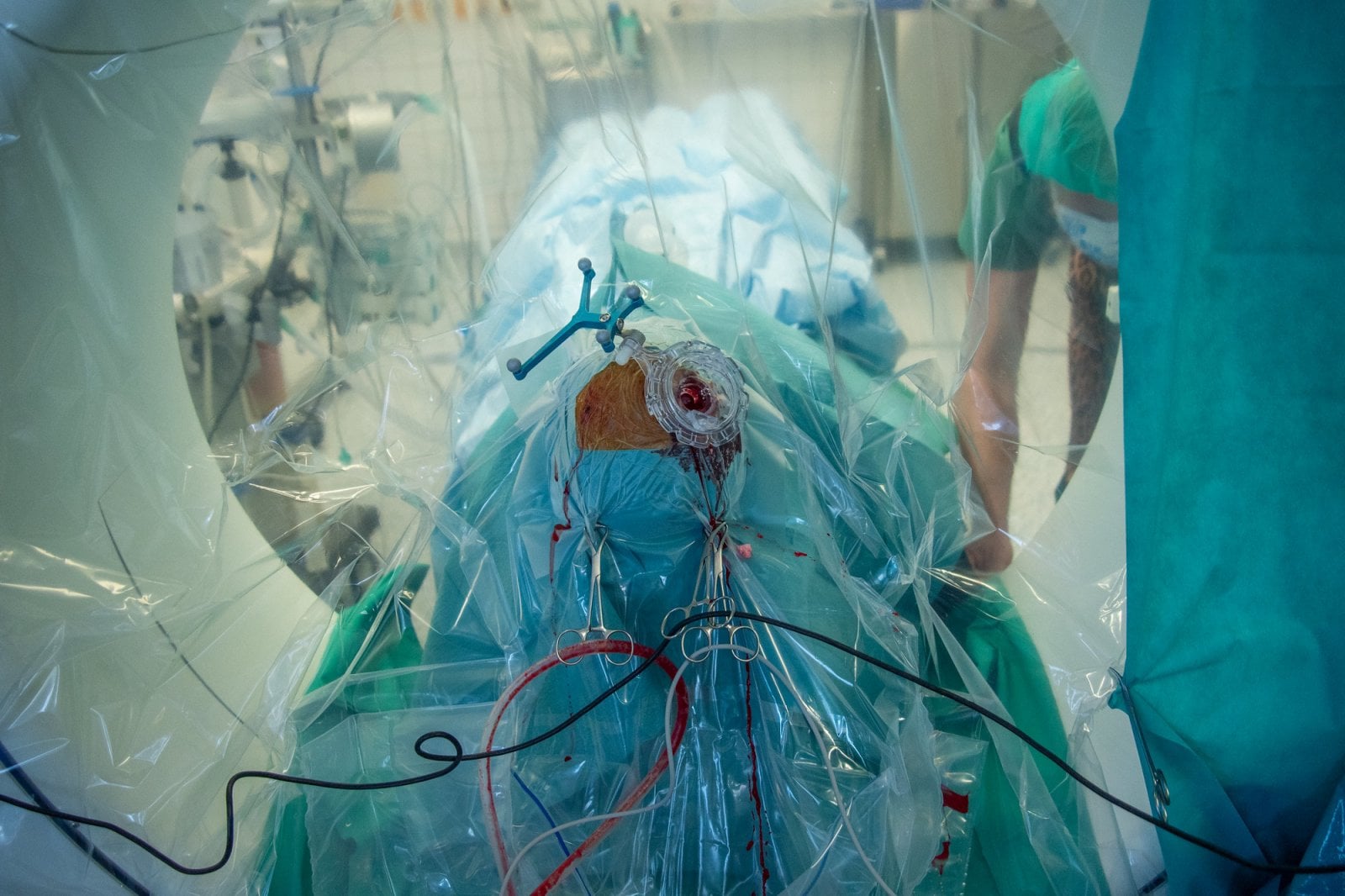 Voperování elektrod do mozku pacienta