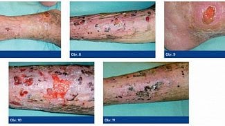 Náhledový obrázek - Léčba chronických ran amniovou membránou má výborné výsledky