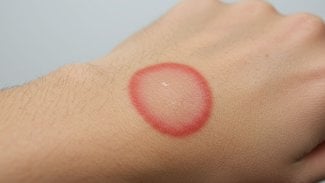 Náhledový obrázek - První příznaky boreliózy: nepřehlédněte varovné signály, jejichž odhalení může pomoci předejít vážným komplikacím