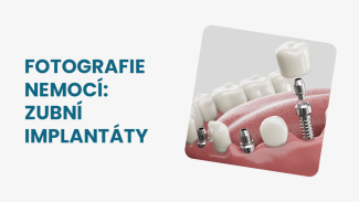 Náhledový obrázek - Zubní implantáty fotografie: jak vypadají a jak se postupuje při jejich zavádění?