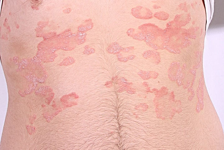 Lupénka (psoriasis)