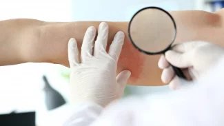 Náhledový obrázek - Léčba pásového oparu může být místní i systémová. Jako prevence pak slouží očkování