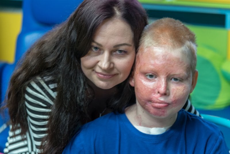 Chlapec utrpěl popáleniny na 50 procentech těla