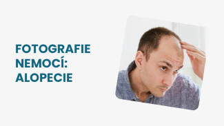 Náhledový obrázek - Alopecie může postihnout muže, ženy i děti. Mohou na ni upozorňovat lámavé vlasy