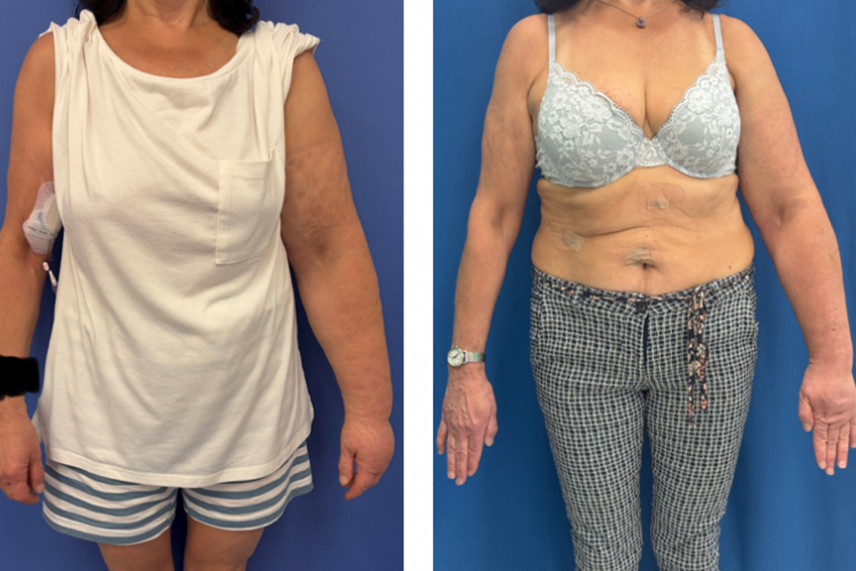 Unikátní operace lymfatických uzlin ve FN Brno