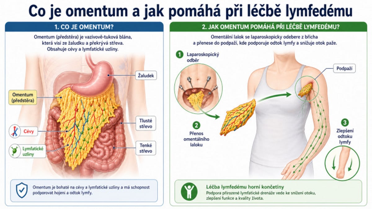 Unikátní operace lymfatických uzlin ve FN Brno