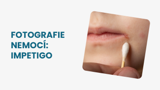 Náhledový obrázek - Impetigo foto: typickým znakem této kožní infekce jsou medově žluté puchýřky