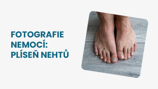 Náhledový obrázek - Plíseň nehtů je častou infekcí. Upozorňuje na ni změna barvy nehtů
