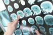 Chceme co nejdříve zabránit imunitnímu systému, aby ničil mozek, říká profesorka Dana Horáková, neuroložka z Centra pro demyelinizační onemocnění (RS Centrum) pražské Všeobecné fakultní nemocnice.