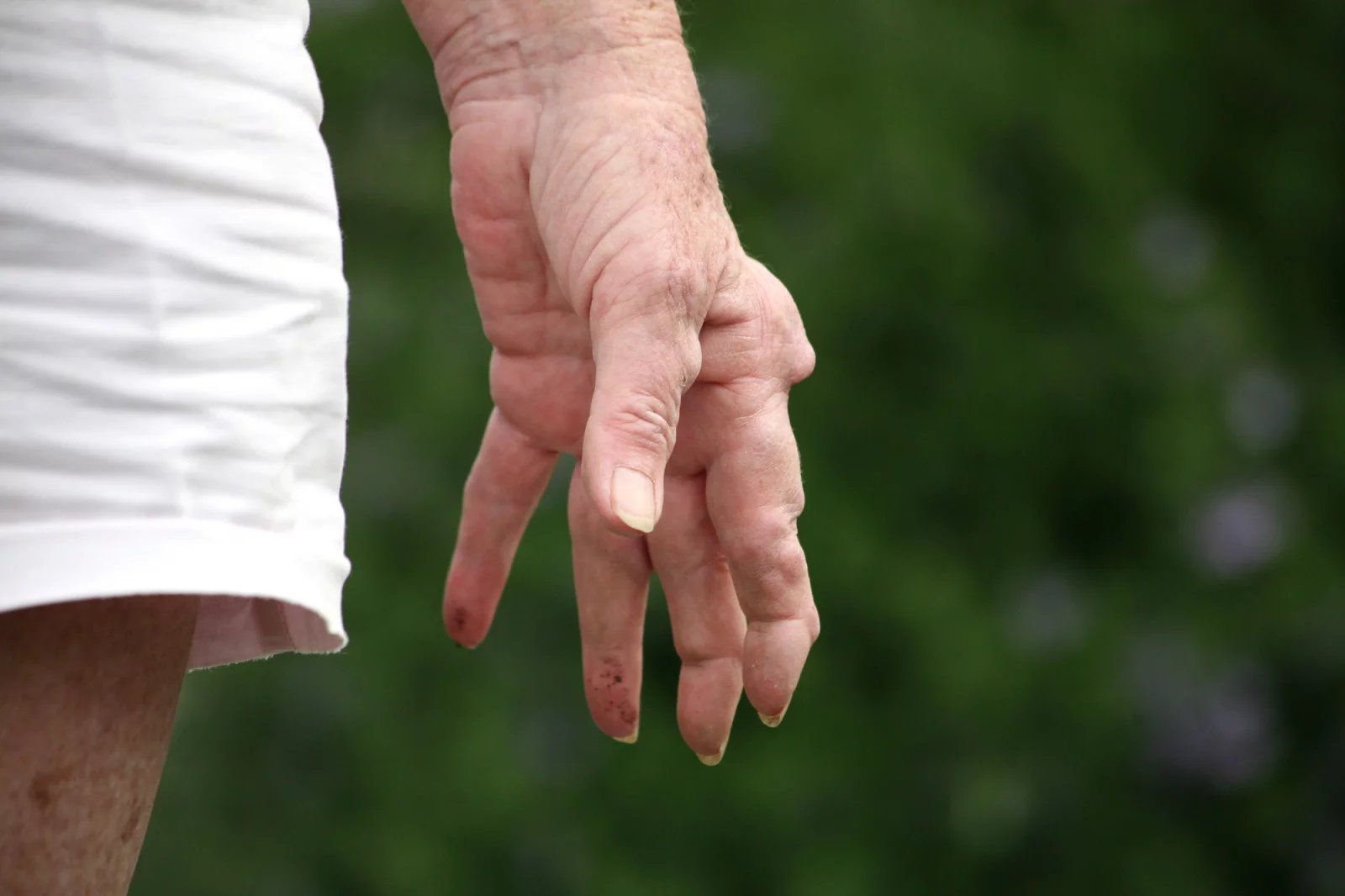 Deformity způsobené revmatoidní artritidou