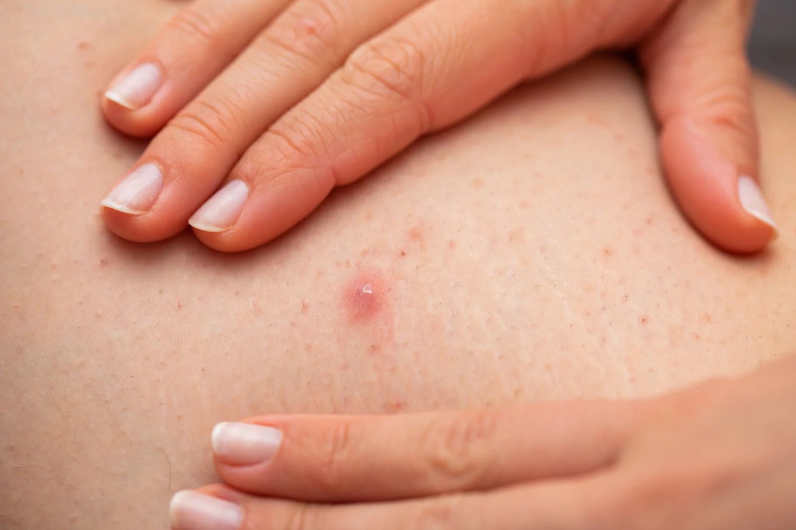 Diagnostiku folikulitidy lze provést běžným vyšetřením na základě vzhledu kůže. K přesnému určení původce zánětu je však zapotřebí provést odebrání vzorku a následné testování.