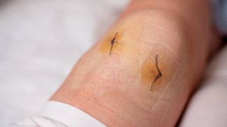 Náhledový obrázek - Artroskopie kolene je diagnostická i léčebná metoda. Lze ji provádět ambulantně