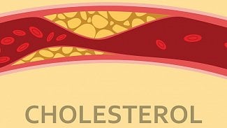 Náhledový obrázek - Jeden ze 200 Čechů má cholesterol zvýšený dědičnou nemocí