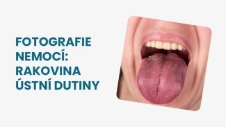 Náhledový obrázek - Rakovina ústní dutiny foto: Jak může nemoc ve skutečnosti vypadat?